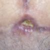 Agujero después de abdominoplastía