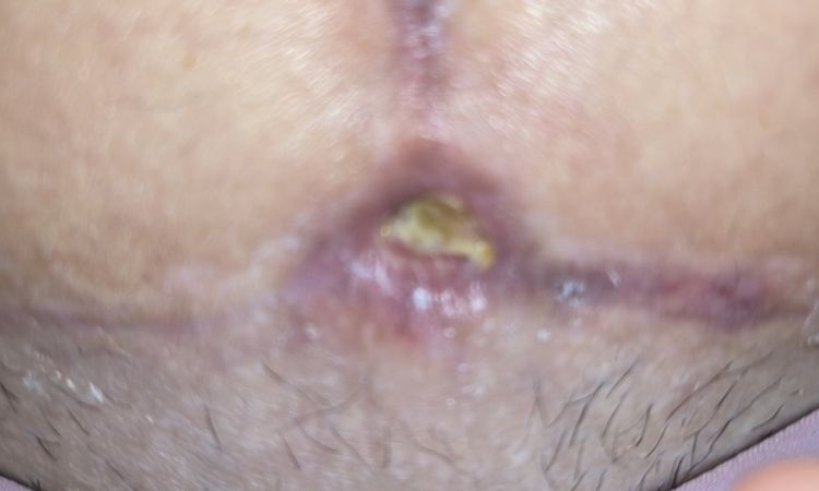 Agujero después de abdominoplastía - 81503