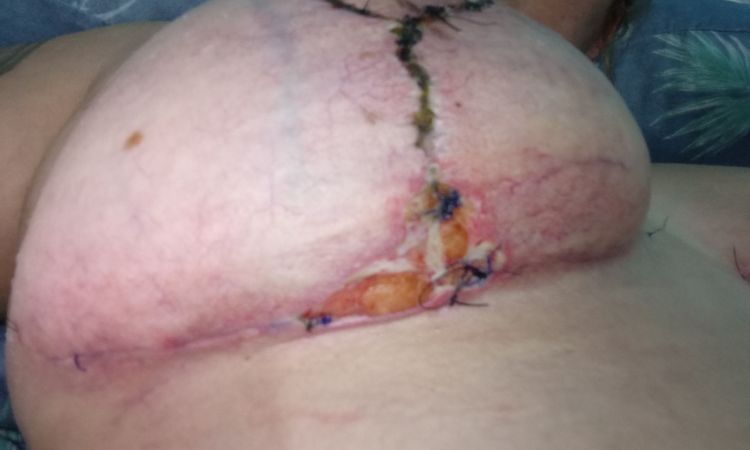 Mastopexia se me abrió en la T invertida - 81667