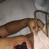 Me salió una quemadura después de mi addominoplastia