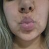 Lipopapada y desvio de labio