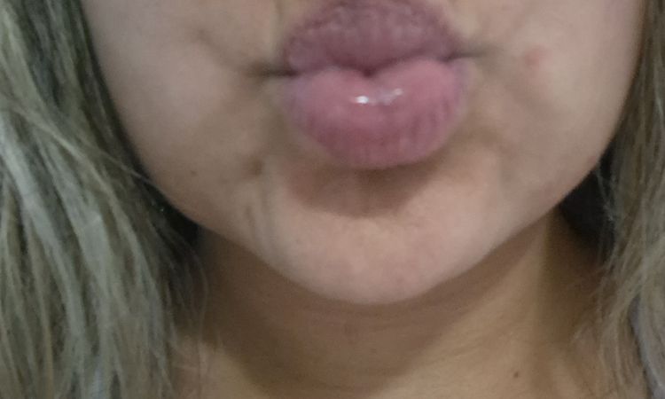 Lipopapada y desvio de labio - 82348
