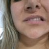 Lipopapada y desvio de labio