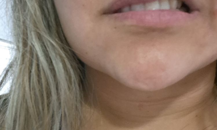 Lipopapada y desvio de labio - 82349