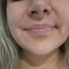 Lipopapada y desvio de labio