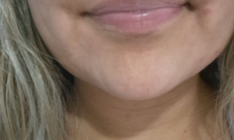Lipopapada y desvio de labio - 82350