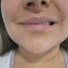 Lipopapada y desvio de labio