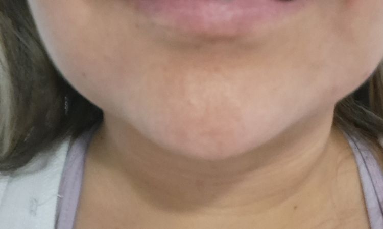 Lipopapada y desvio de labio - 82351