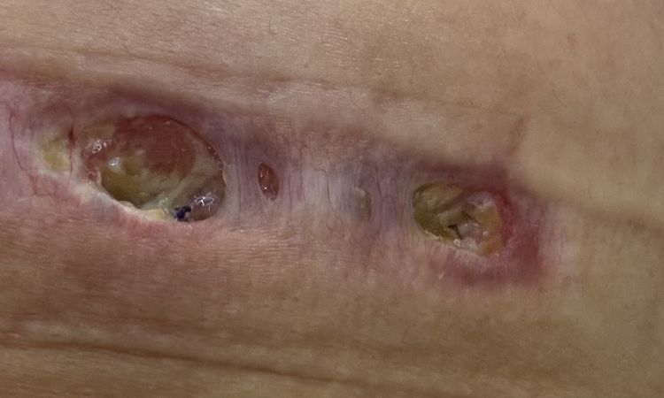 Herida abierta tras tres meses de aumento mamario - 82463