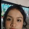 Bichectomía en jóvenes y hilos tensores
