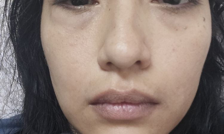 Ojo hinchado por carboxiterapia - 82827