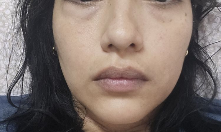 Ojo hinchado por carboxiterapia - 82828