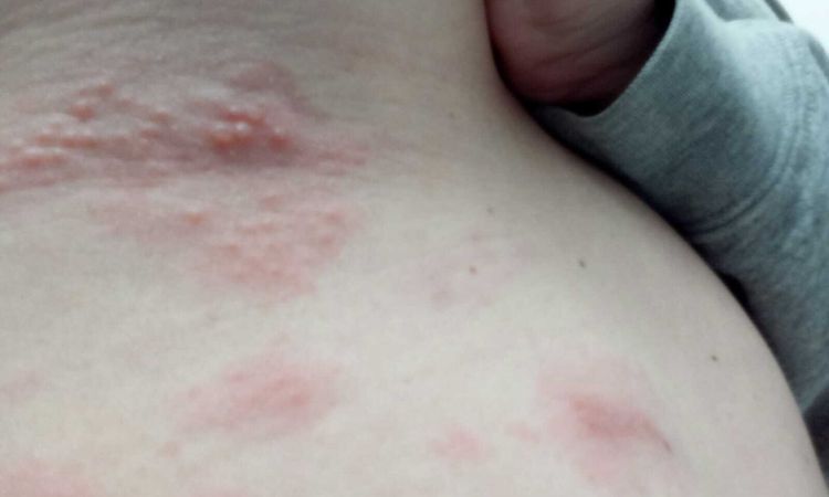 Problemas con mis implantes o es otra situación - 84050