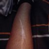 Cicatriz de 12 CM y más de 25 años hecha por un alambre
