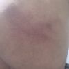 Despues de un golpe q tube en mi glutio me duelle