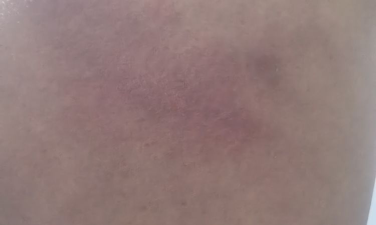 Despues de un golpe q tube en mi glutio me duelle - 84772