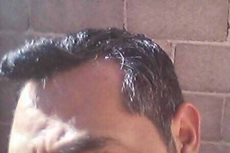 Costo de trasplante de cabello