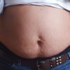 Abdominoplastia  o miniabdominoplastia?