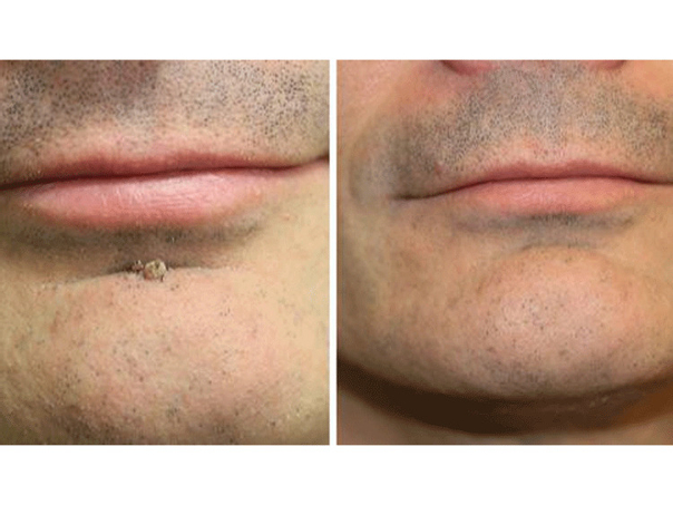 Antes y después de eliminación de verrugas 