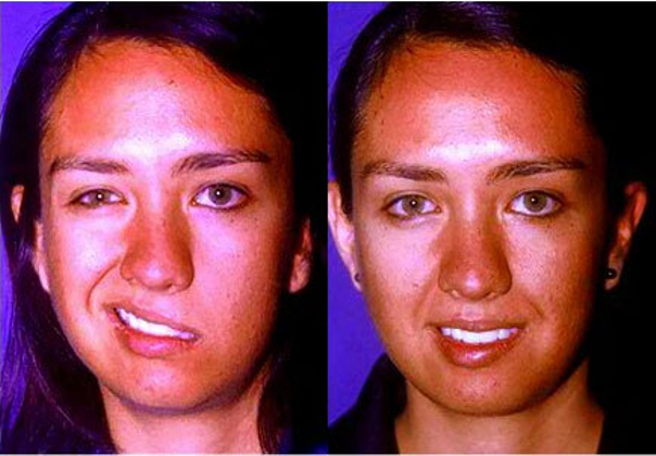 Antes y después de cirugía maxilofacial 