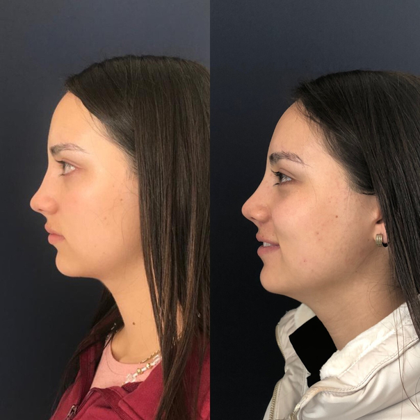 Antes y después de la mentoplastia