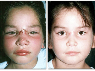 Objetivos de la cirugía para cicatrices