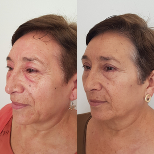 Técnicas blefaroplastia