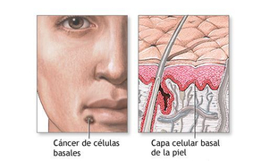 ¿Cómo se realiza el tratamiento para combatir el carcinoma basocelular?