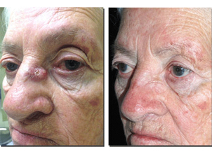 Algunos cuidados post operatorios: