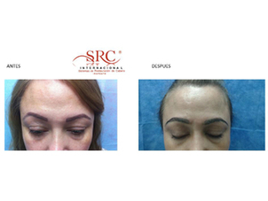 Alopecia antes y después