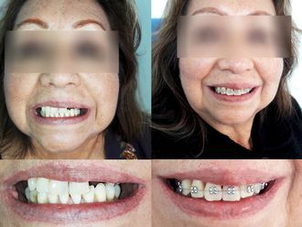 antes y después implantes dentales