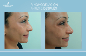 Antes y después rinomodelación