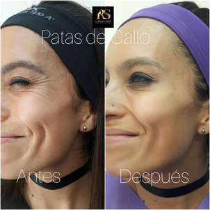 Rejuvenecimiento Facial