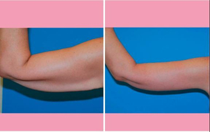 ¿Cómo es la recuperación después de una braquioplastia?