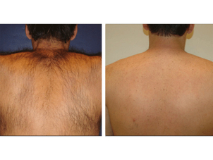 Antes y después de la depilación