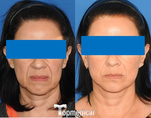 Antes y después lifting