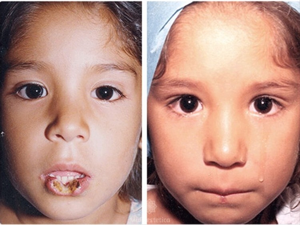 Antes y después quelioplastia