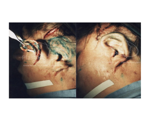 Antes y después de una cirugía plástica reconstructiva