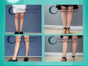 Antes y después aumento pantorrillas