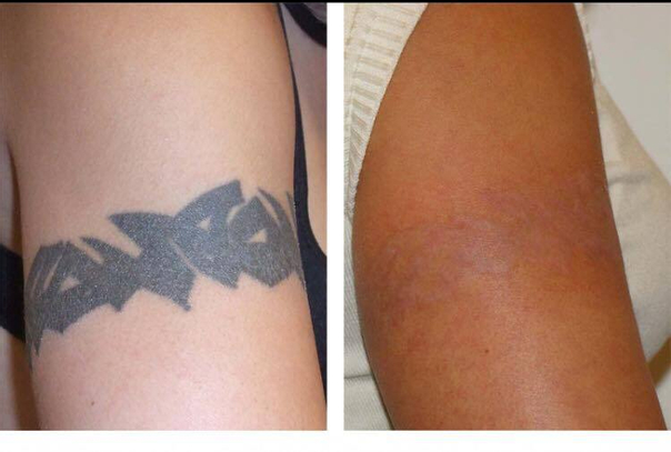 Antes y después de eliminar tatuaje