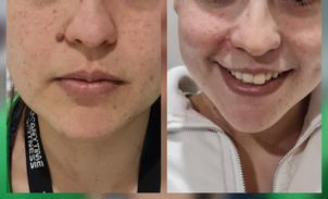 Eliminación de lunares