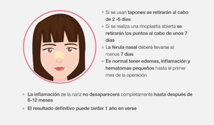 Rinoplastia