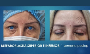 Antes y después de blefaroplastia