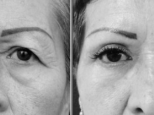 Antes y después blefaroplastia