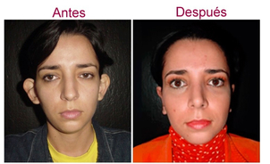Antes y después de otoplastia