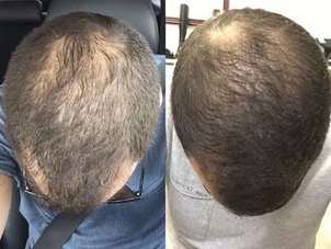 Antes y después alopecia