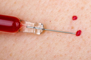 Eliminación de lunares