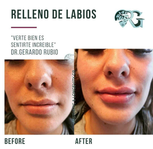 Antes y después aumento de labios