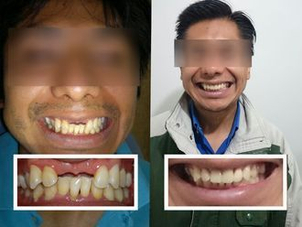 antes y después implantes