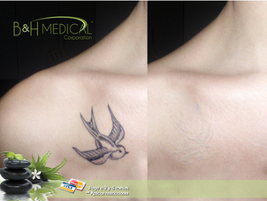 Resultados eliminación de tatuajes